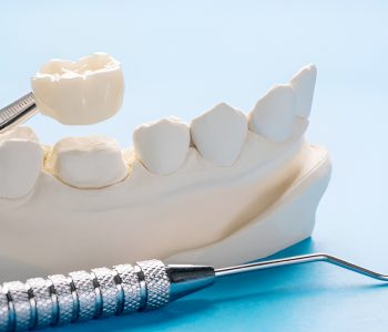 dental crown removed from a dental cast model