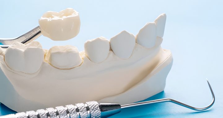 dental crown removed from a dental cast model